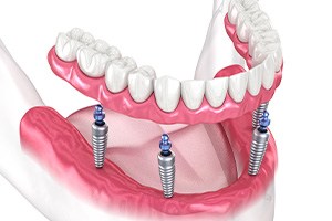 Digital image of All-on-4 dentures