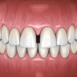 Illustration of diastema in upper front teeth with black background