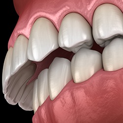 Illustrated closeup of overbite with black background