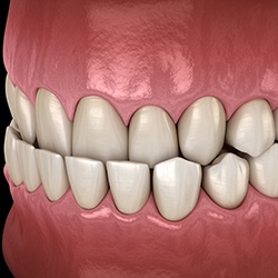Illustrated profile view of underbite with black background
