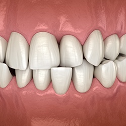 Illustrated closeup of crossbite with black background