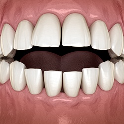 Illustrated frontal view of open bite with black background