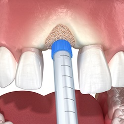 Illustration of bone graft at site of lost tooth