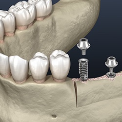 Two implants being placed at site of ridge expansion