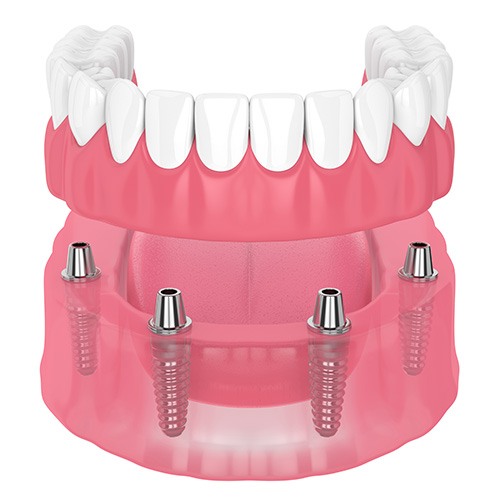 Illustration of an implant denture in Minot, ND