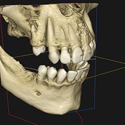 CBCT image on computer monitor