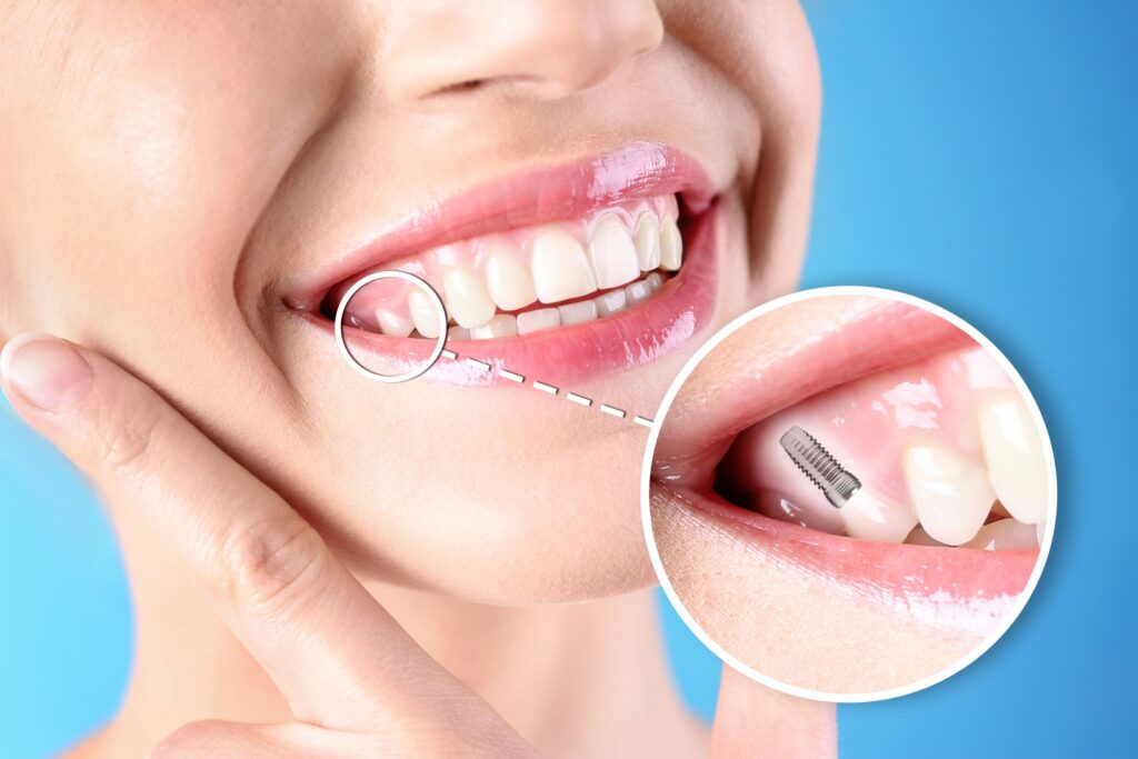 Nose-to-chin view of woman smiling in front of blue background with one tooth indicated as an implant